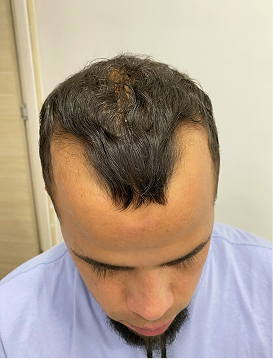 Diferentes tipos de alopecia (androgenética, areata, por tracción, universal, según diagnóstico)